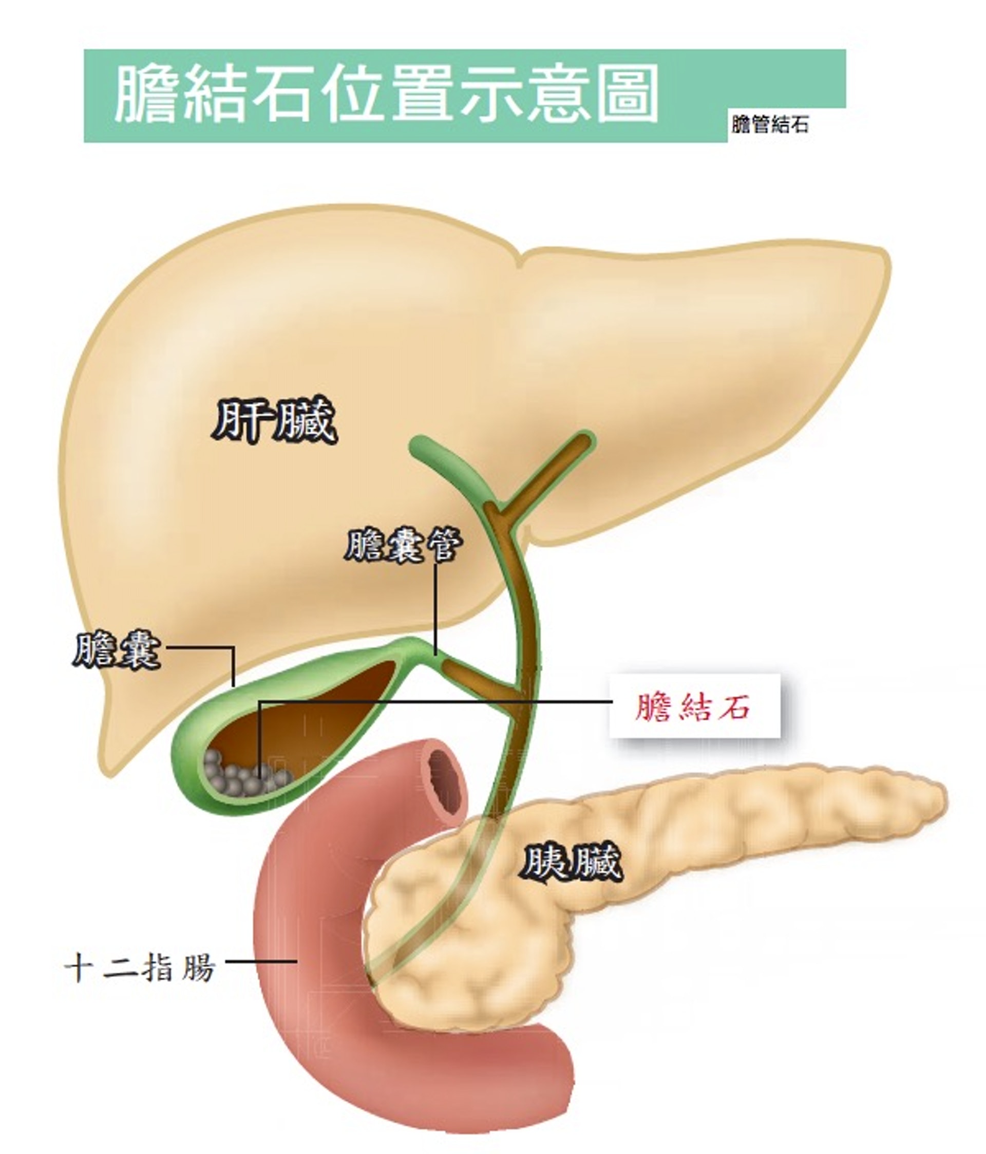 膽結石是指在膽囊或膽管內形成的硬塊。（圖片：肝病防治學術基金會）