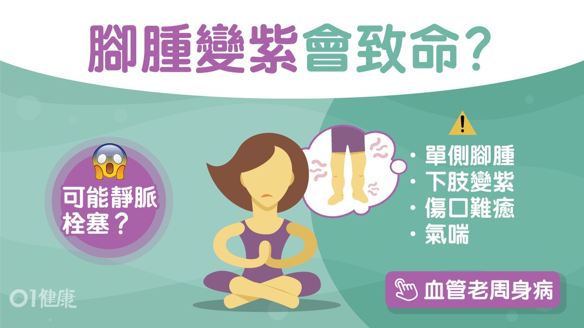 血栓|單腳腫發紫4症狀靜脈栓塞嚴重需截肢!暢通靜脈一定要開刀? 血栓|單腳腫發紫4症狀靜脈栓塞嚴重需截肢!暢通靜脈一定要開刀?