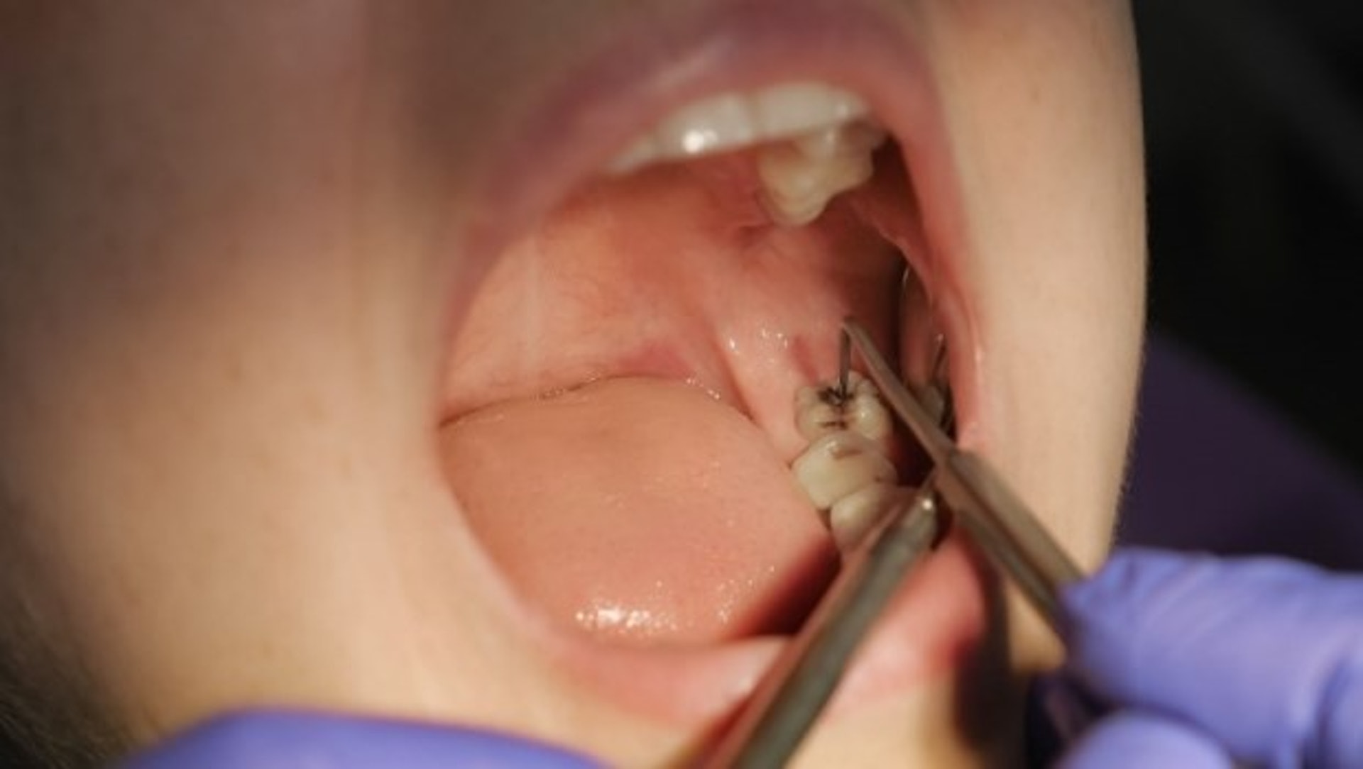 初期蛀牙難以察覺，定期檢查牙齒才能及早發現及根治。（圖片：Business Weekly）