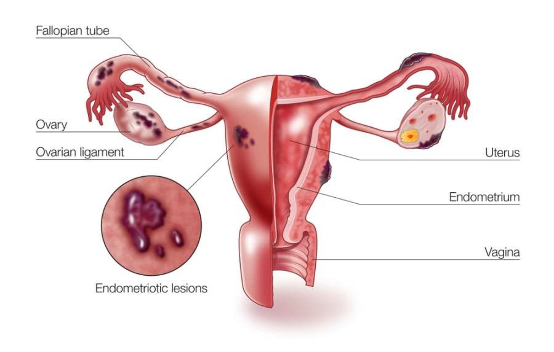 子宮內膜異位是指內膜細胞生長在子宮以外的位置，例如輸卵管、卵巢或是其他盆腔位置。