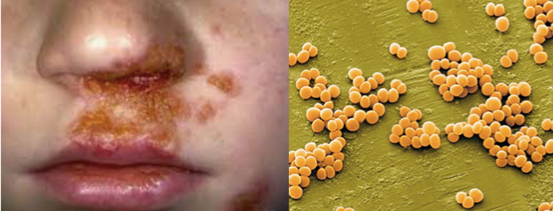 有撩鼻習慣的人容易感染金黃色葡萄球菌，令鼻腔、面部皮膚等受感染的部位出現紅腫、觸痛甚至膿疱、膿瘡及流膿。（圖片：naver）