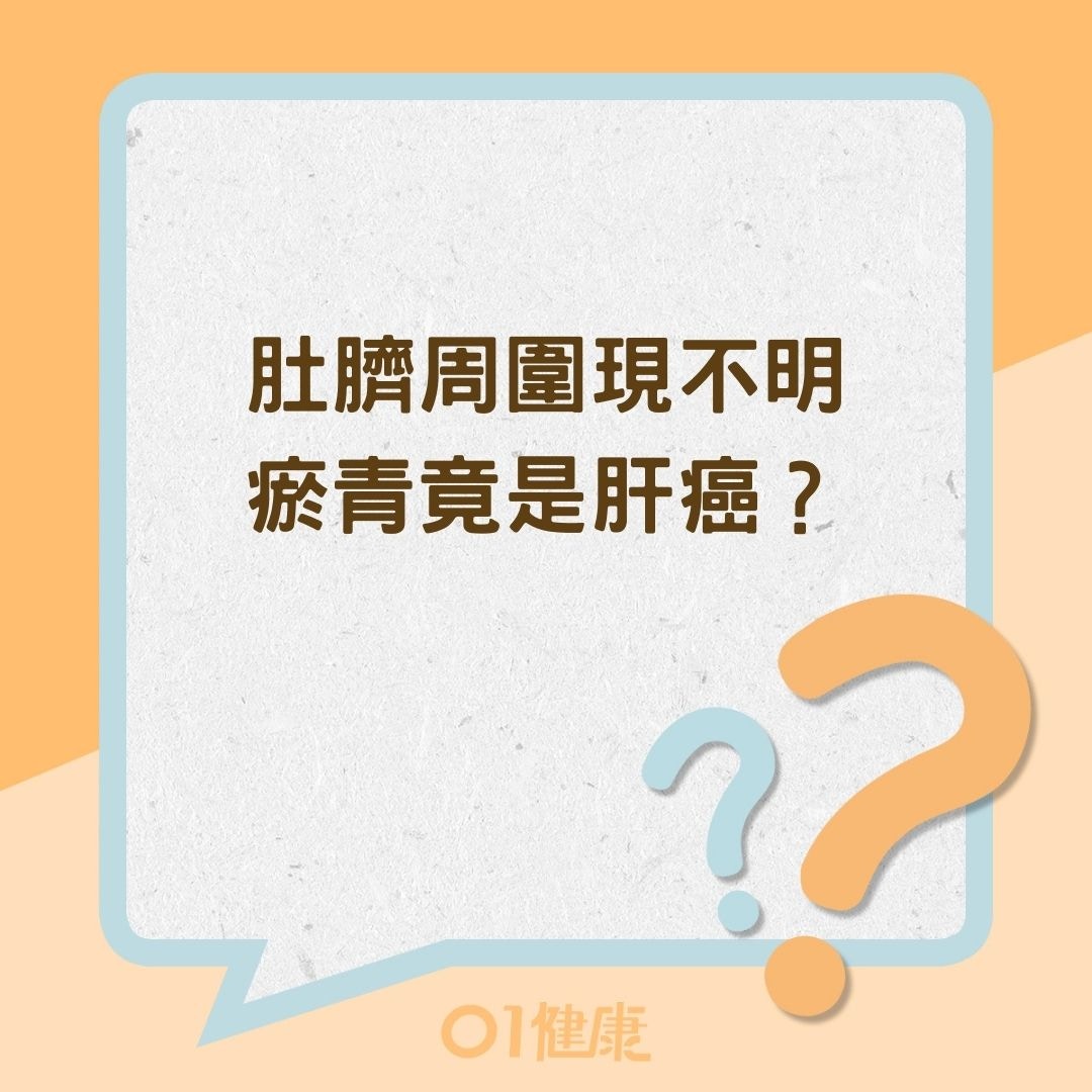 肚臍周圍現不明瘀青竟是肝癌？（01製圖）