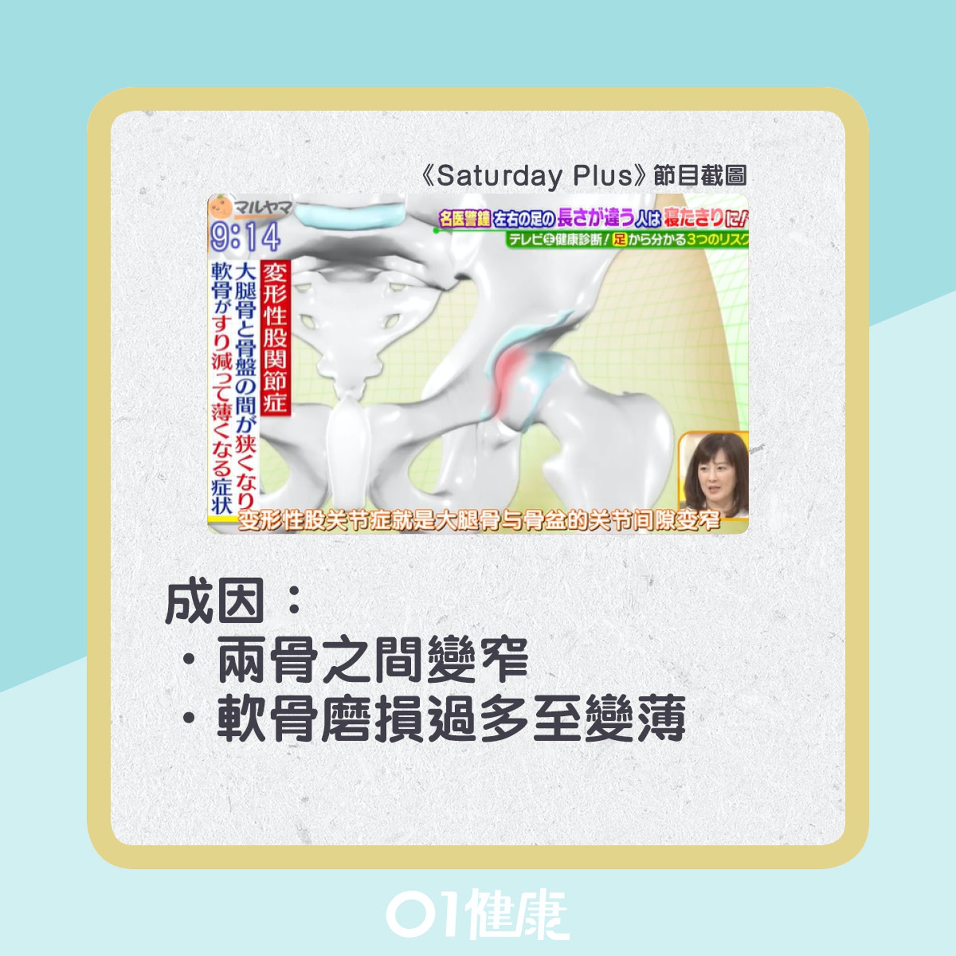 髖關節炎成因。(01製圖) 髖關節炎成因。(01製圖)