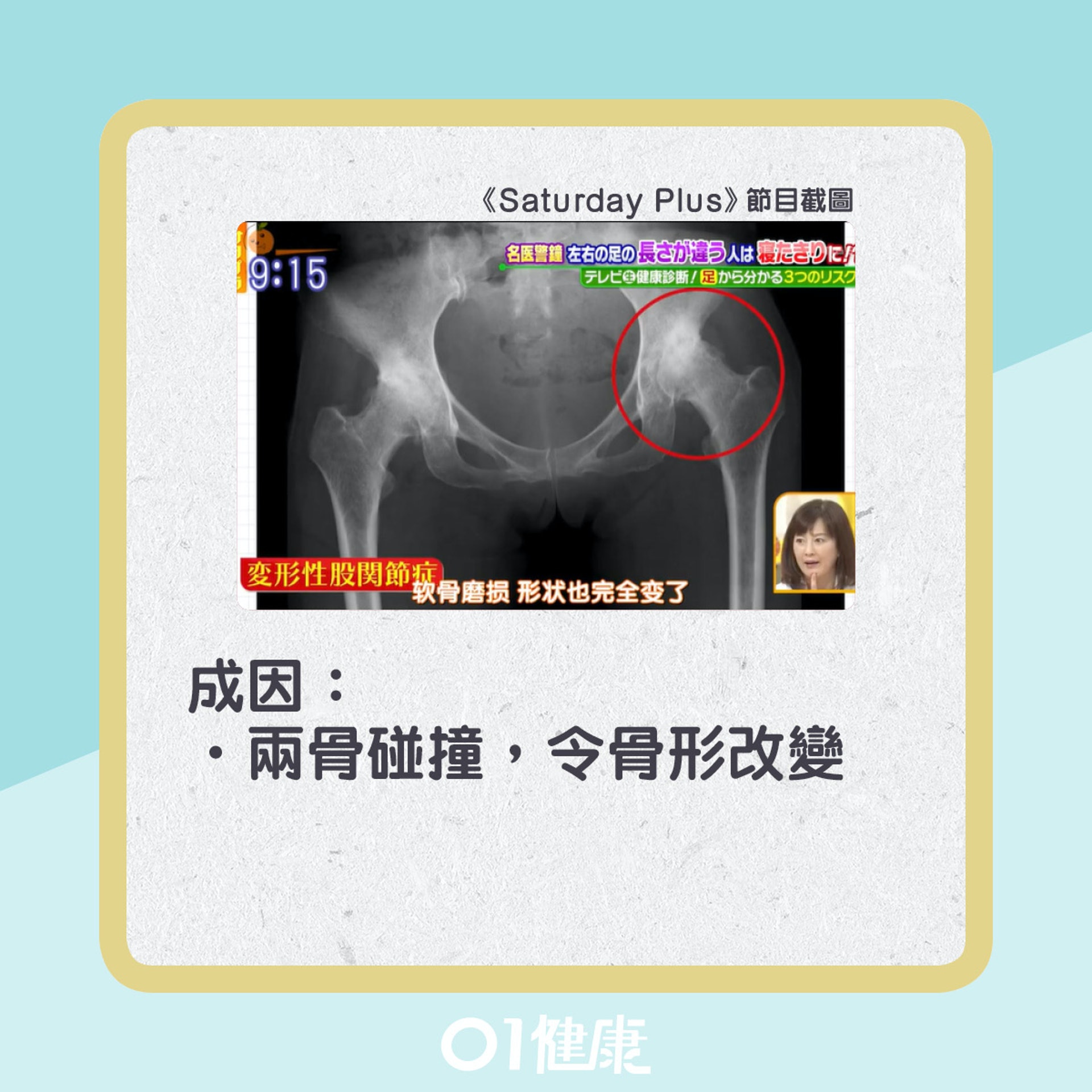 髖關節炎成因。(01製圖) 髖關節炎成因。(01製圖)