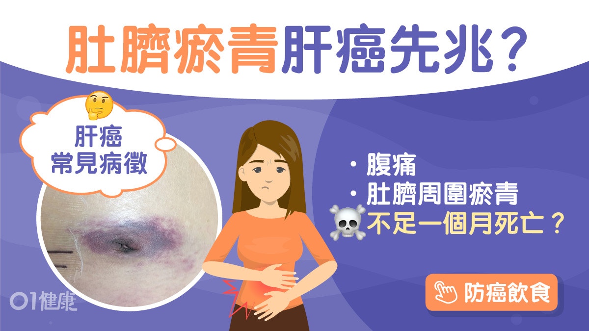 肝癌｜男肚臍旁現不明瘀青肝癌末期！腳腫冇胃口10症狀初期難察覺