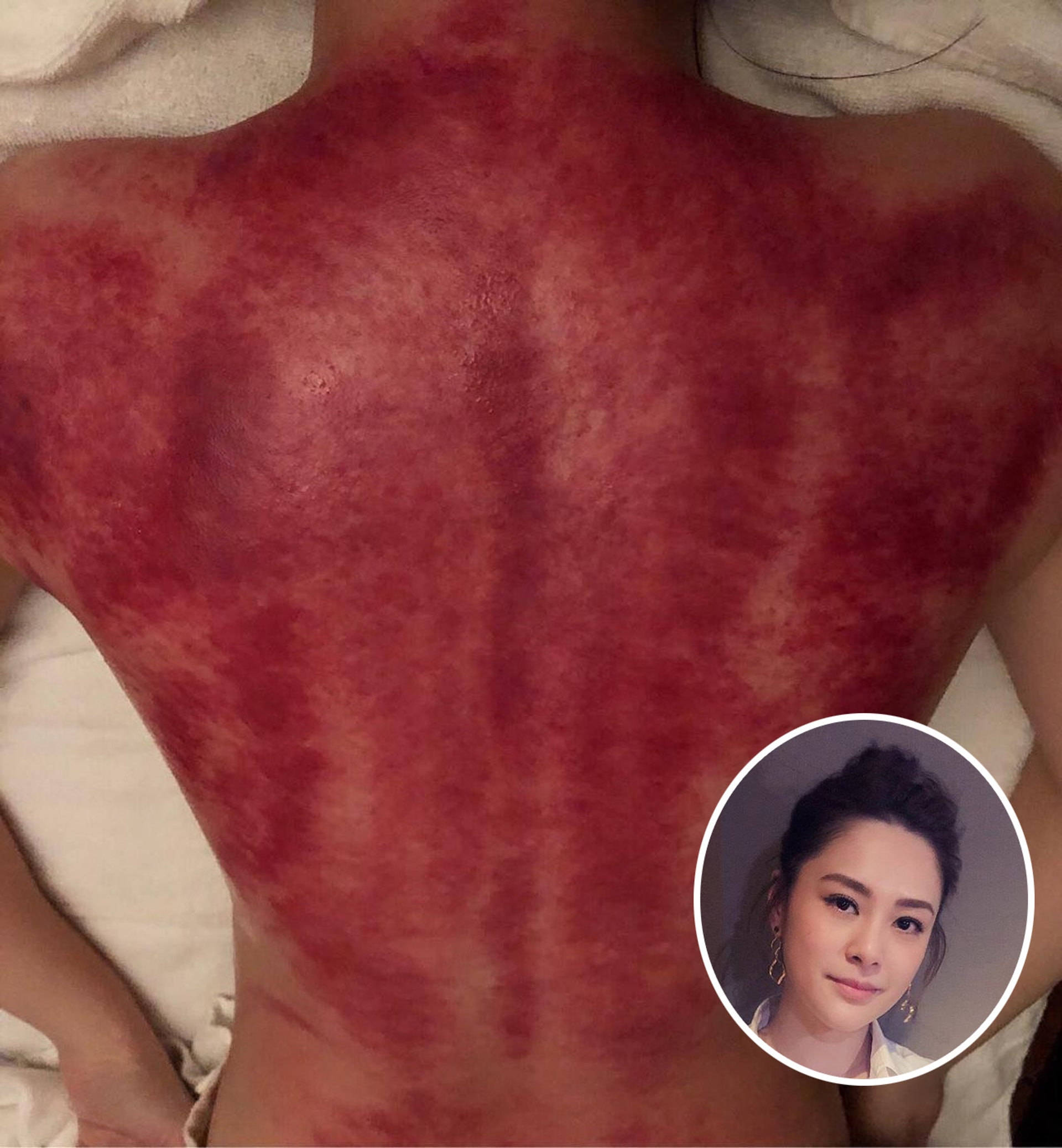出痧代表毒素排出體外,深紅、深紫等顏色代表健康狀況不佳,但不一定顏色愈深愈有效。圖為阿嬌上載自己刮痧後的照片。(圖片:HK01) 出痧代表毒素排出體外,深紅、深紫等顏色代表健康狀況不佳,但不一定顏色愈深愈有效。圖為阿嬌上載自己刮痧後的照片。(圖片:HK01)