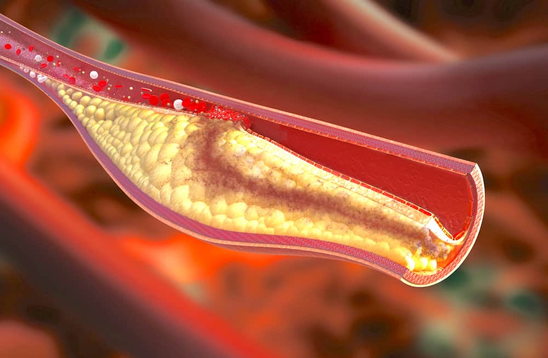 當血液中的膽固醇過高，便有可能在血管內壁上積聚。（圖片：Pinterest）