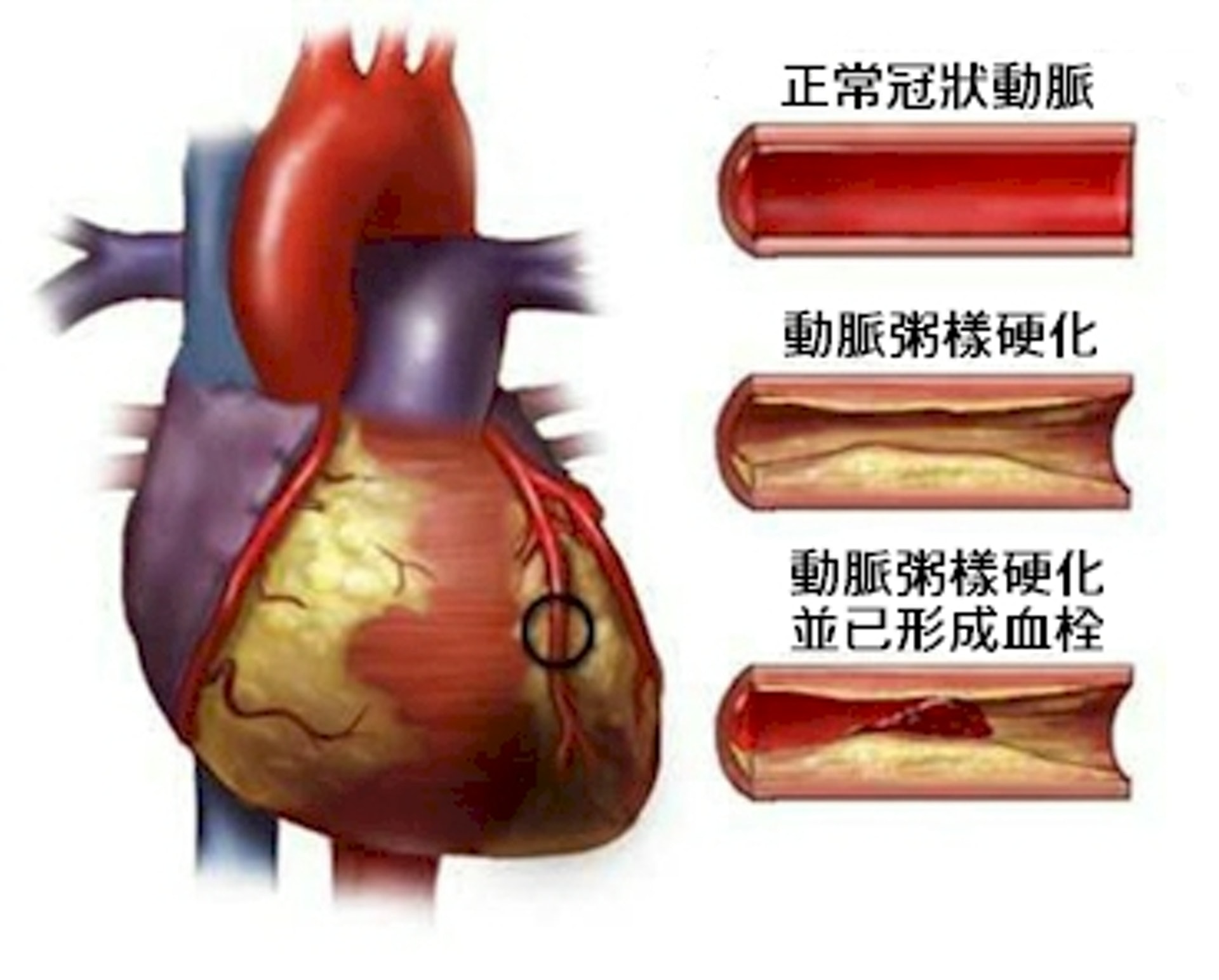 血液中的膽固醇若使冠狀動脈閉塞，更會引致「冠心病」。（圖片：香港體育教學網）