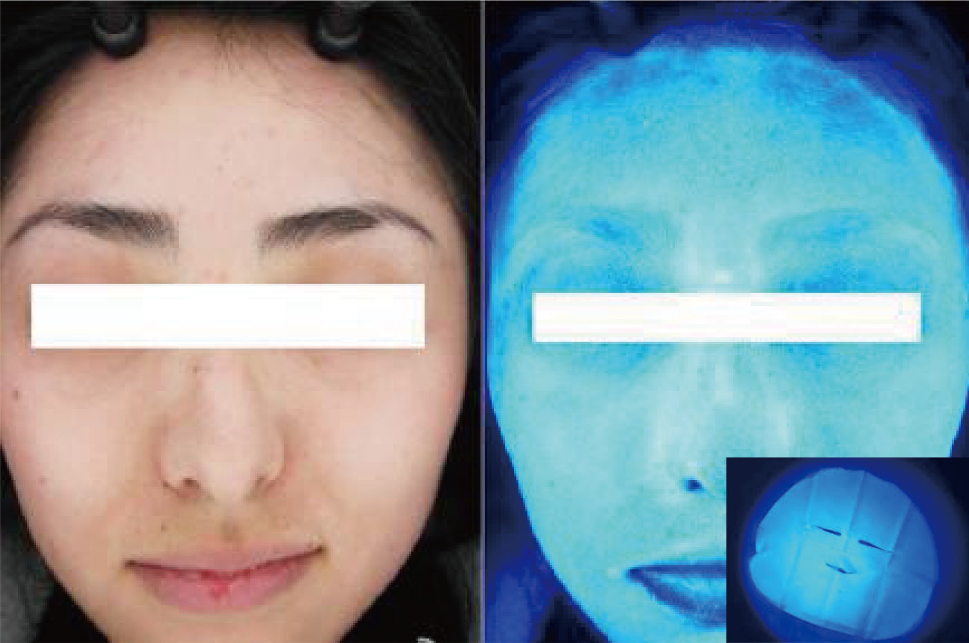 如面膜含有螢光劑，殘留臉上令毛孔變得粗大、多皺紋。（圖片：網絡）