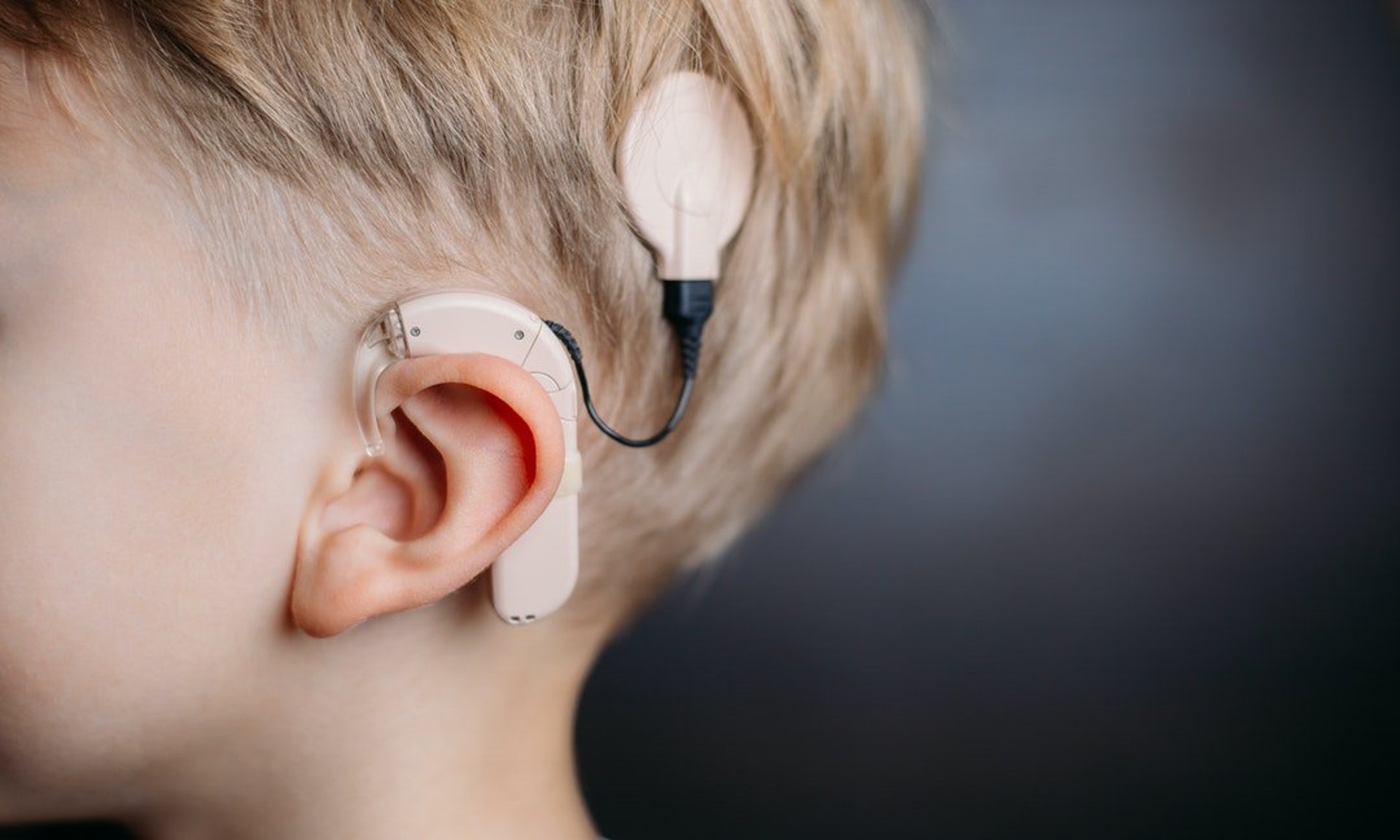 人工耳蝸，故名思義是代替耳蝸的功能，能避開某些受損部位，直接刺激聽覺神經，幫助聲音傳送至大腦，是助聽器無法做到。（圖片：wjkuo）