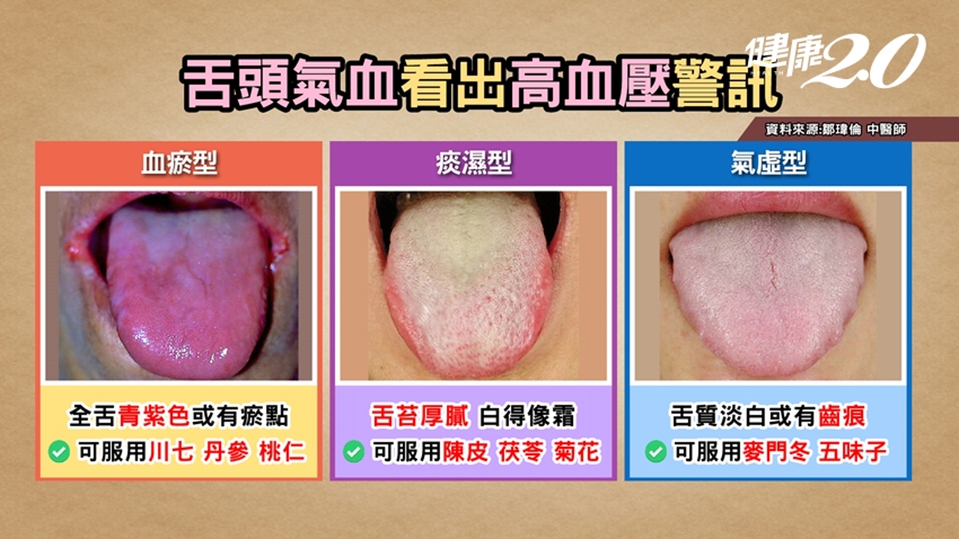 舌頭氣血看出高血壓警訊(健康2.0授權使用) 舌頭氣血看出高血壓警訊(健康2.0授權使用)