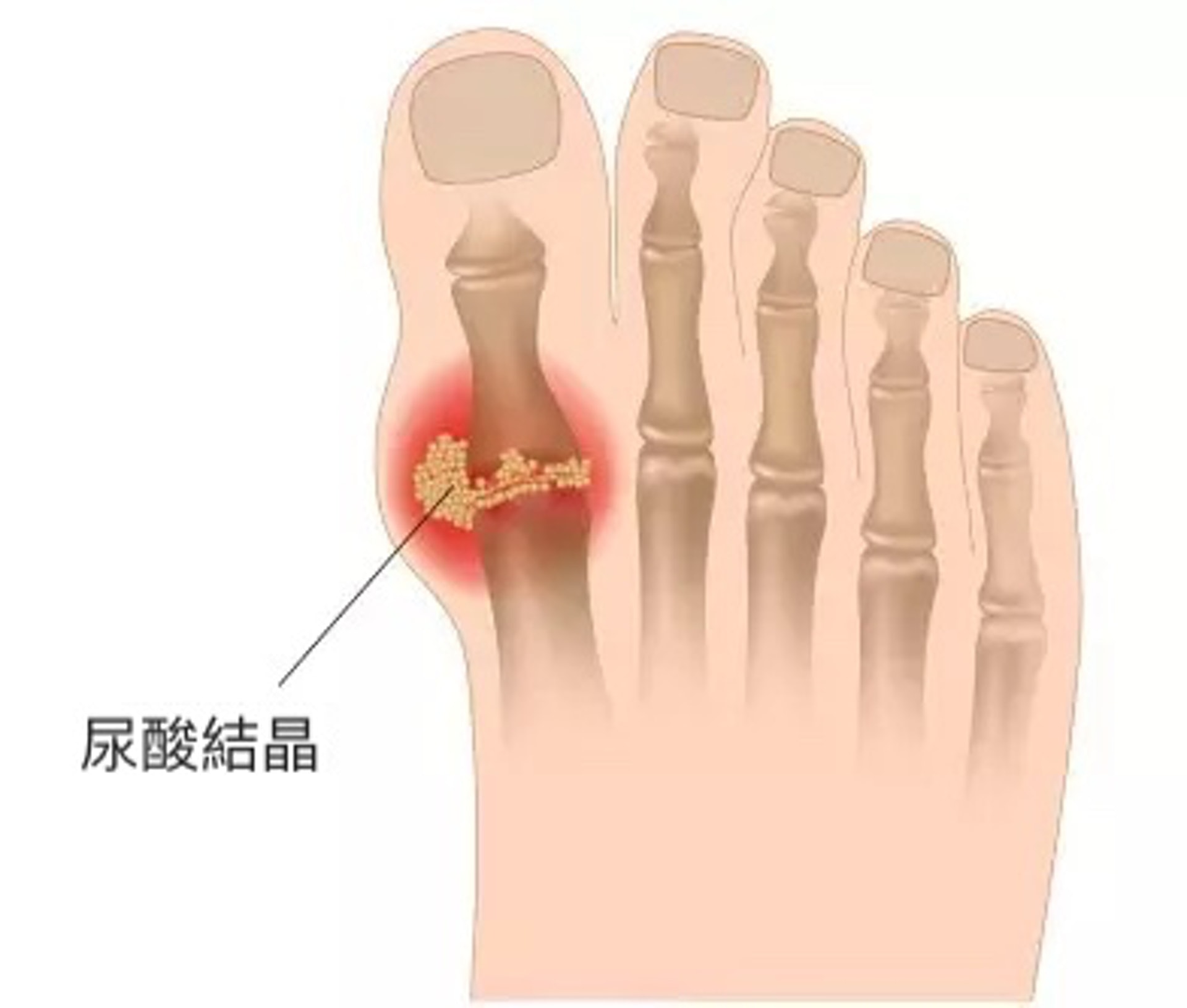 「痛風」全名是「痛風性關節炎」，因過量的尿酸會在體內累積，形成結晶體，沉積在關節處，引致關節發炎和劇痛。（圖片：ifun01）