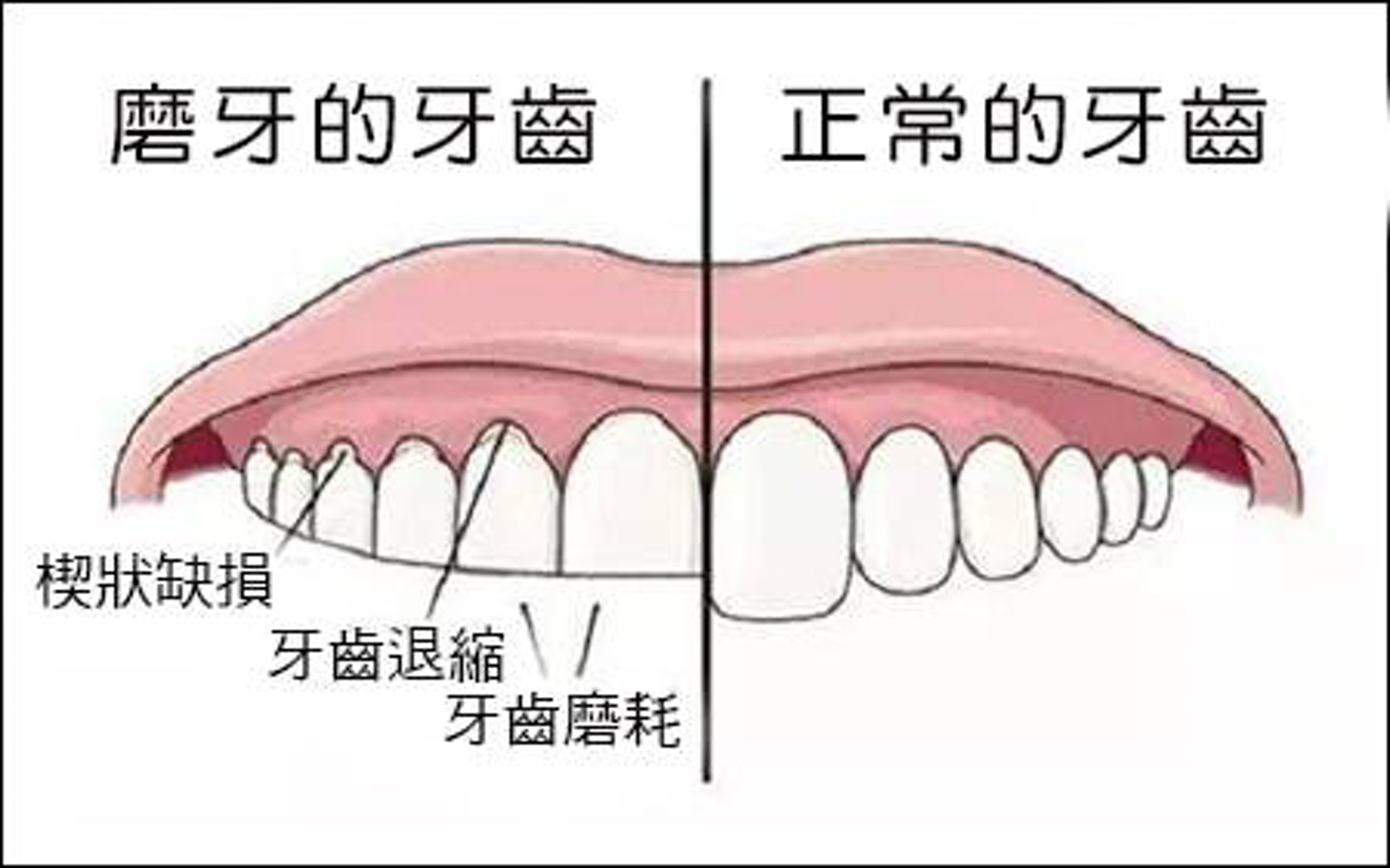 磨牙最大壞處是損蝕琺瑯質,令象牙質外露;而象牙質較柔軟,保護力不及琺瑯質,令牙齒磨蝕得更快。(圖片:today.line.me) 磨牙最大壞處是損蝕琺瑯質,令象牙質外露;而象牙質較柔軟,保護力不及琺瑯質,令牙齒磨蝕得更快。(圖片:today.line.me)