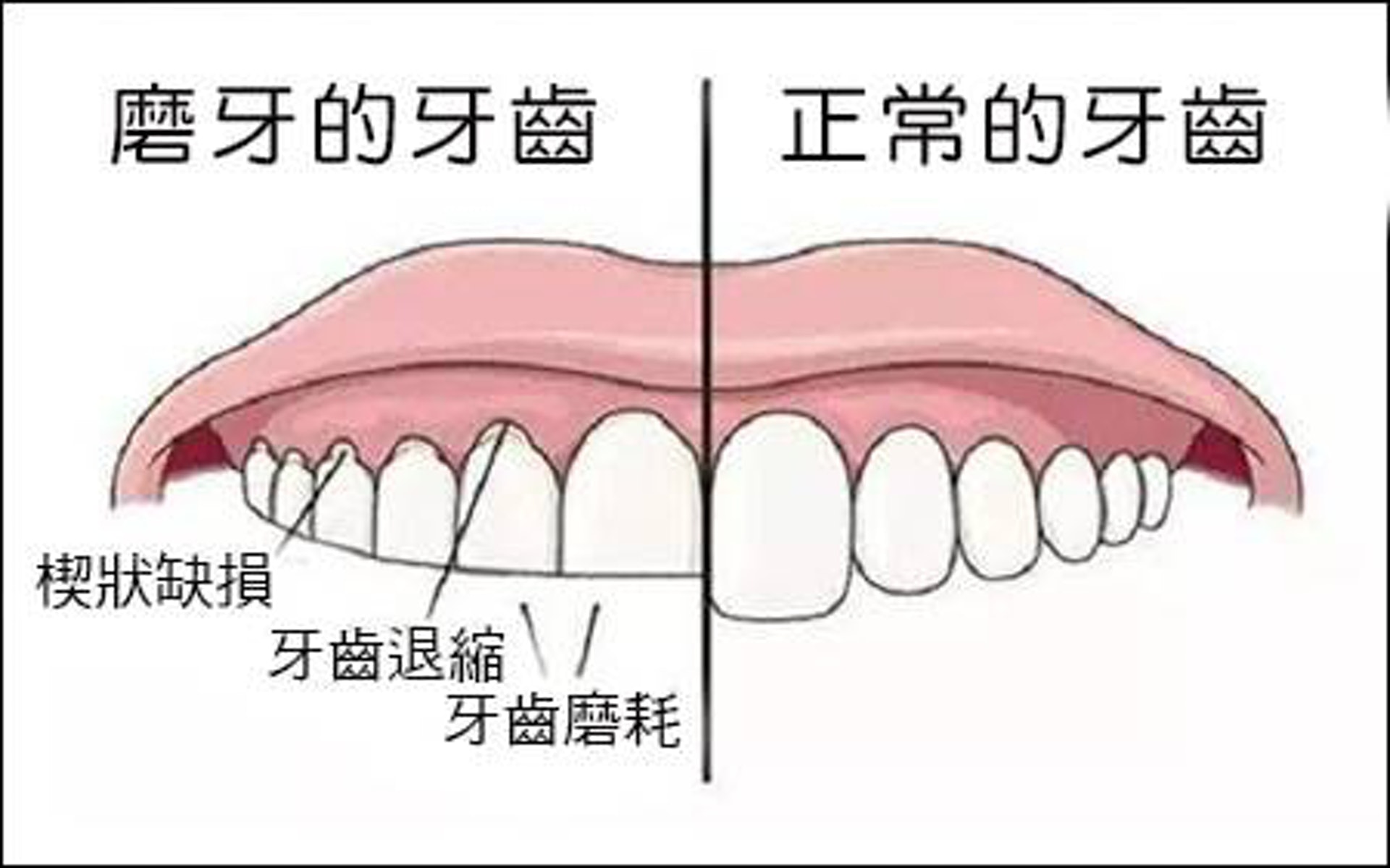 磨牙最大壞處是損蝕琺瑯質，令象牙質外露；而象牙質較柔軟，保護力不及琺瑯質，令牙齒磨蝕得更快。（圖片：today.line.me）