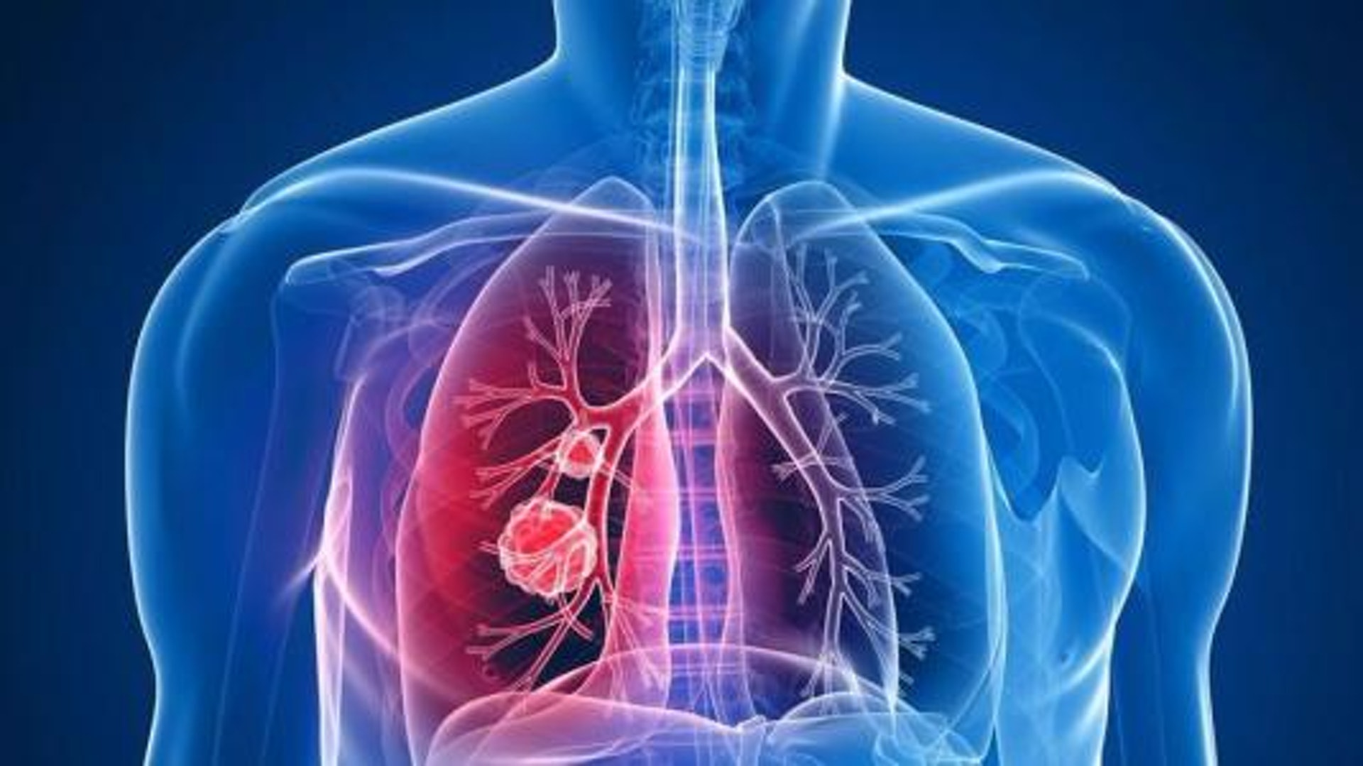 根據臨牀觀察，肺結節的情況十分常見，而當中九成以上都不是癌症。（圖片：香港保健協會）
