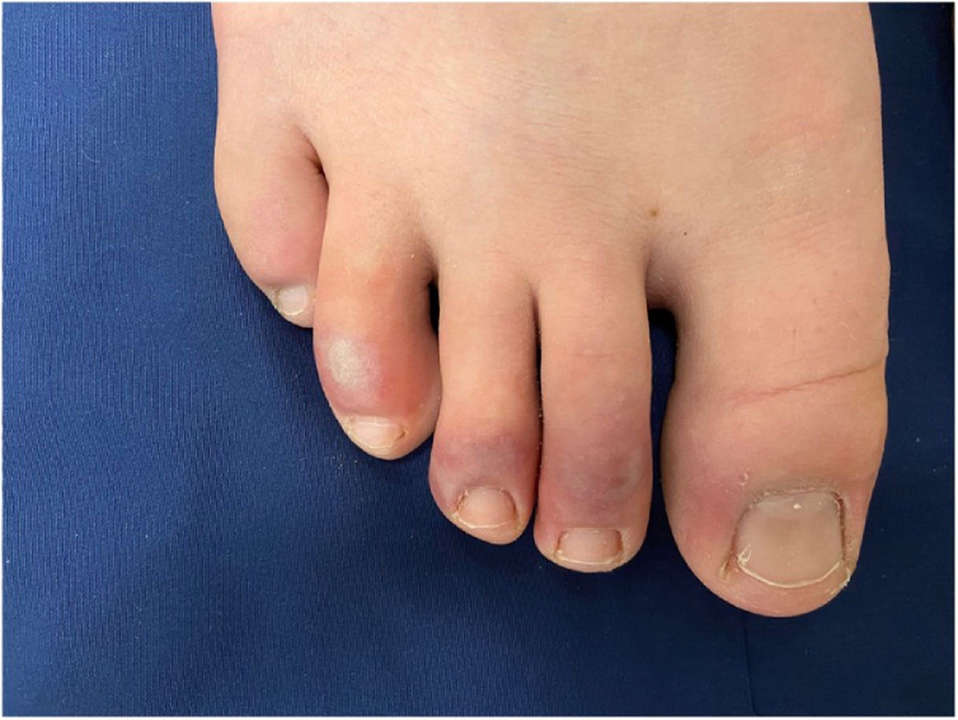 新冠腳趾」部份患者腳部浮腫至無法穿鞋歐洲新研究找到成因