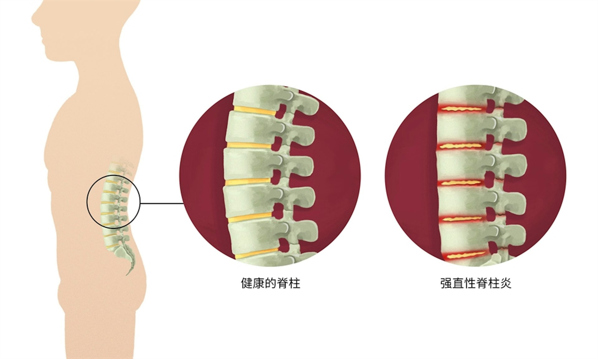 強直性脊椎炎持續會使骨骼增生及融合，導致關節僵硬，移動幅度嚴重受限，患者會失去靈活度。（圖片：doctorsaustralia）