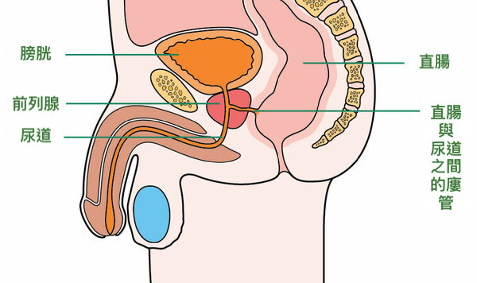 「直腸前列腺瘻」即直腸和前列腺之間有廔管形成，令尿液和精液會通過直腸和肛門排出，而糞便又經尿道排出。（圖片：macmillan）