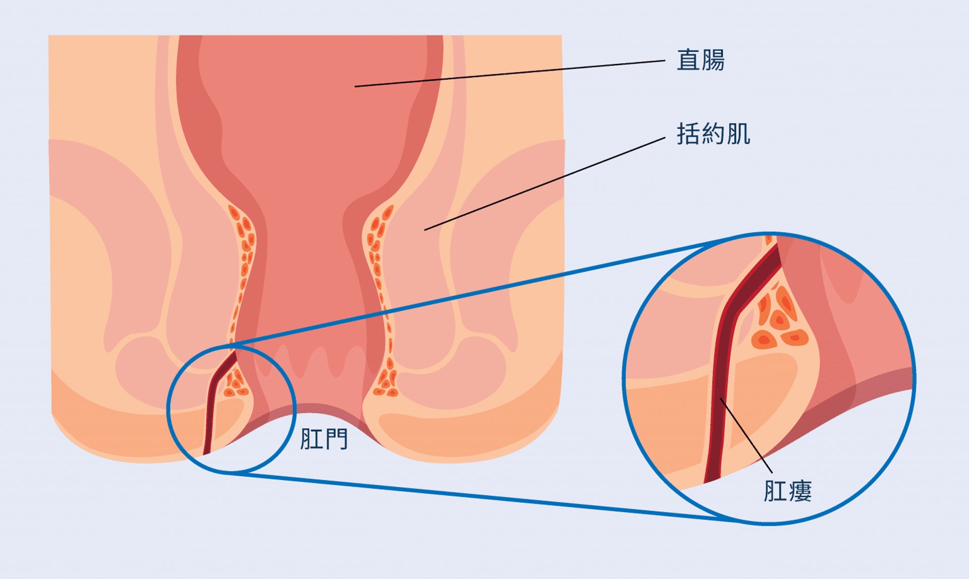 肛門瘻管在肛門直腸內和肛門外圍的皮膚形成。開口和肛門直腸相通，令開口會不斷受糞便和細菌污染，造成感染，最終發炎。（圖片：ICON專科中心）