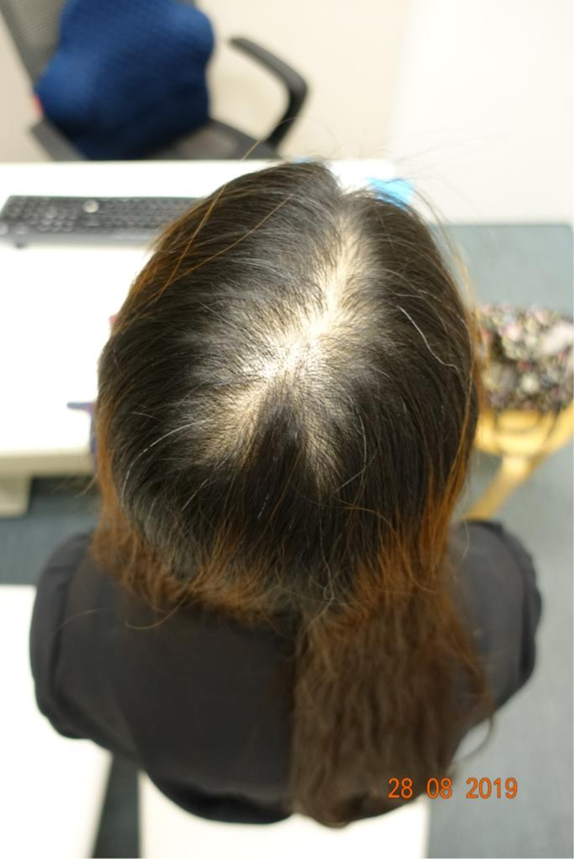 脂溢性頭皮炎病人在遠志中醫接受治療的前後對比圖。(圖片:遠志中醫) 脂溢性頭皮炎病人在遠志中醫接受治療的前後對比圖。(圖片:遠志中醫)