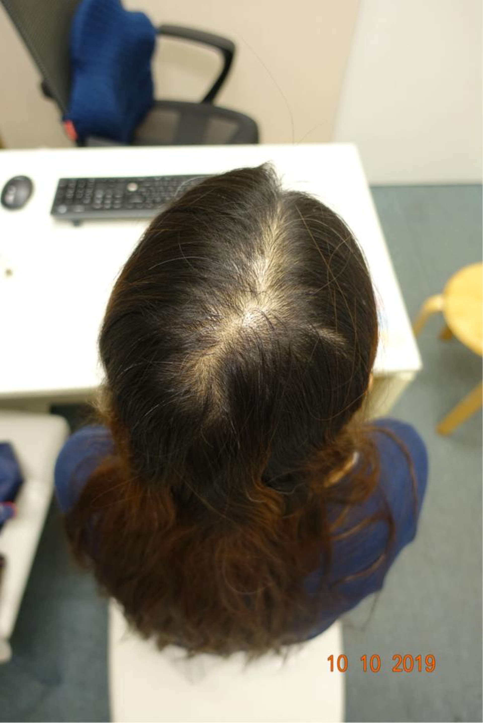 脂溢性頭皮炎病人在遠志中醫接受治療的前後對比圖。（圖片：遠志中醫）