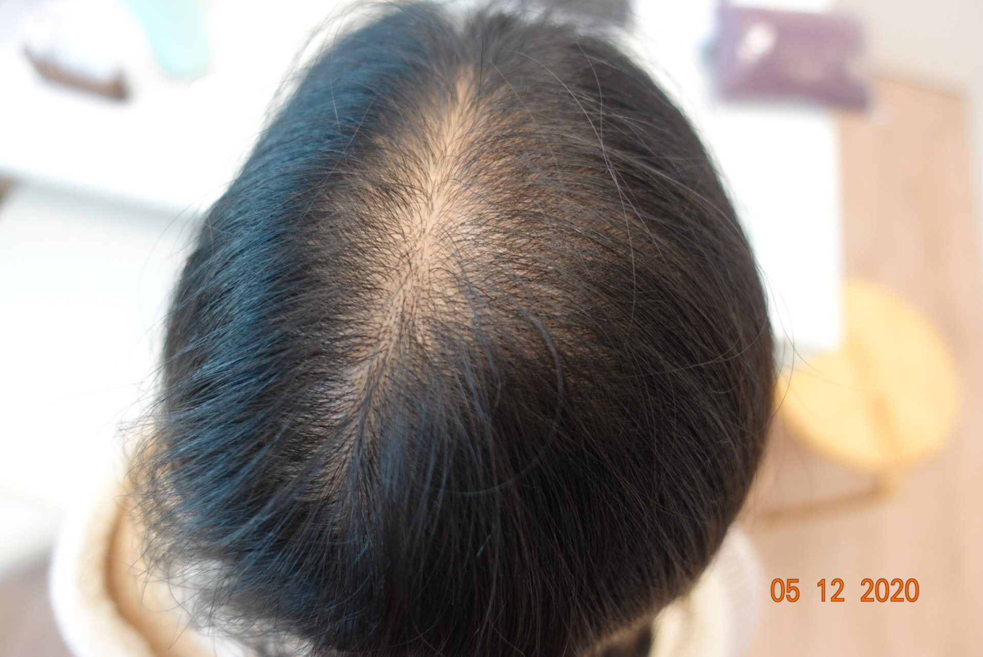 「壓力和情緒」是脫髮成因之一,圖為年僅33歲的媽媽在生活壓力下出現脫髮。(圖片:遠志中醫) 「壓力和情緒」是脫髮成因之一,圖為年僅33歲的媽媽在生活壓力下出現脫髮。(圖片:遠志中醫)