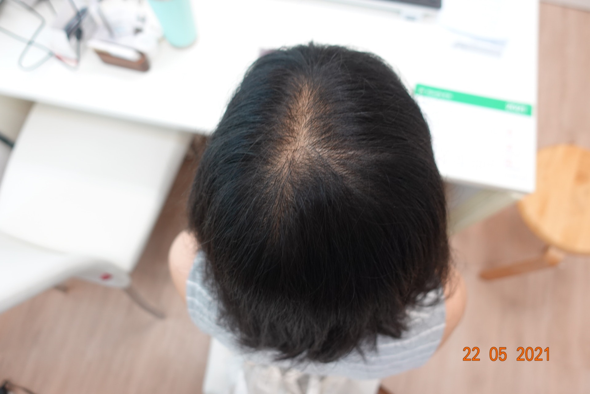 「壓力和情緒」是脫髮成因之一,圖為年僅33歲的媽媽在生活壓力下出現脫髮。(圖片:遠志中醫) 「壓力和情緒」是脫髮成因之一,圖為年僅33歲的媽媽在生活壓力下出現脫髮。(圖片:遠志中醫)