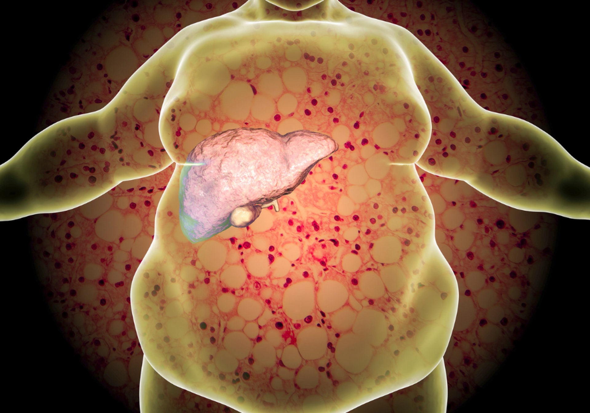 肥胖和飲酒引起的脂肪肝及酒精性肝炎，會進一步引起肝硬化及肝癌。（圖片：Canva）