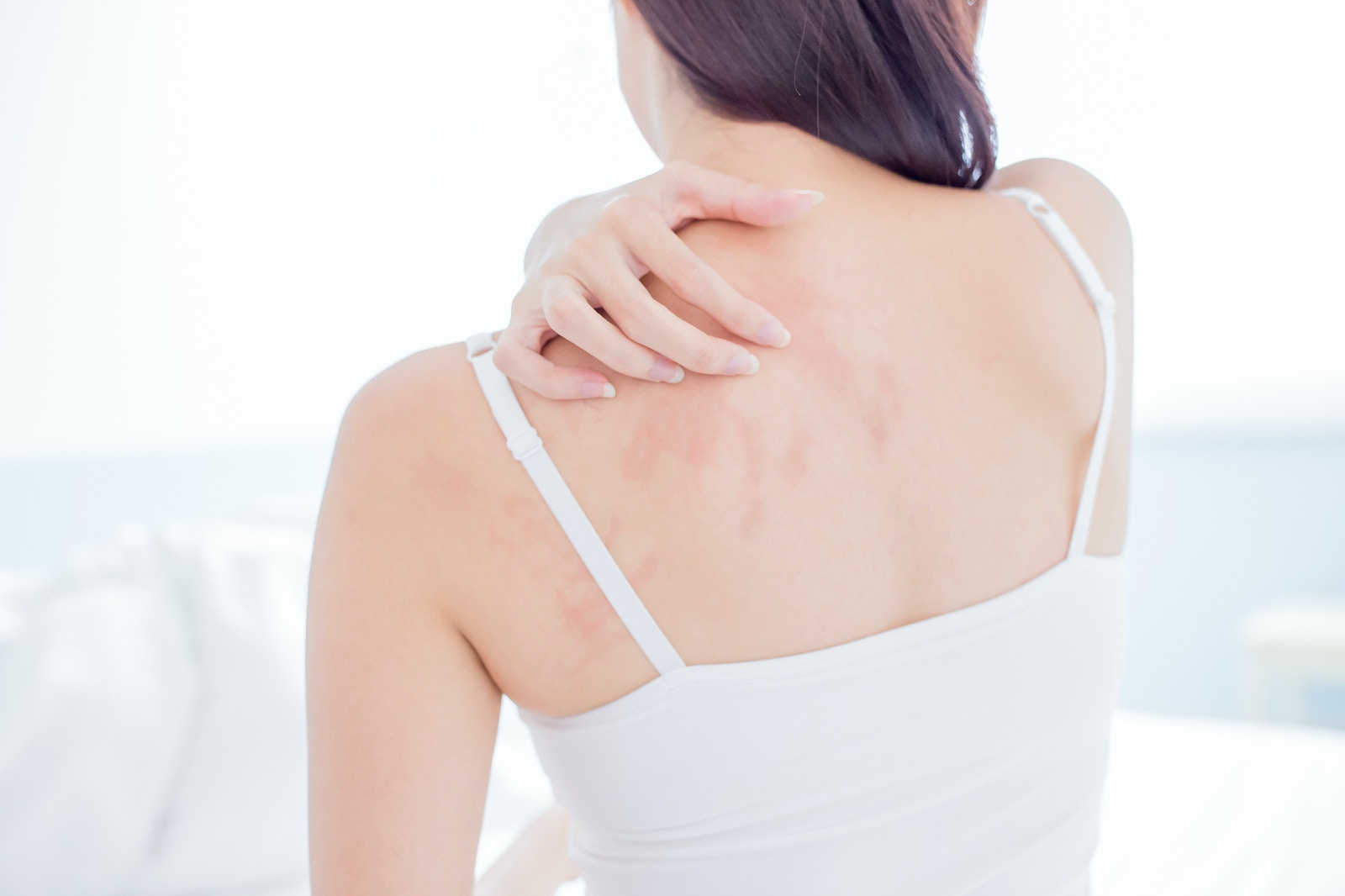 Light sensitivity causes skin rashes, blisters, allergens, residual