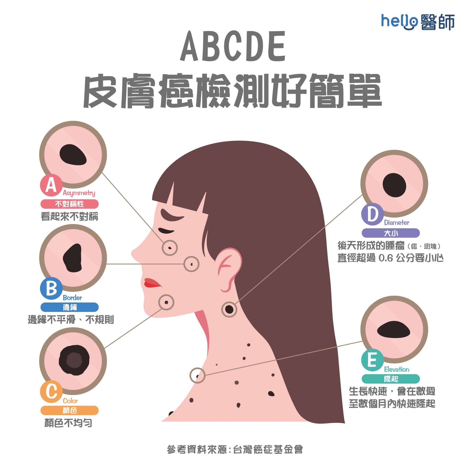 如何自行檢查皮膚癌(Hello醫師授權使用) 如何自行檢查皮膚癌(Hello醫師授權使用)