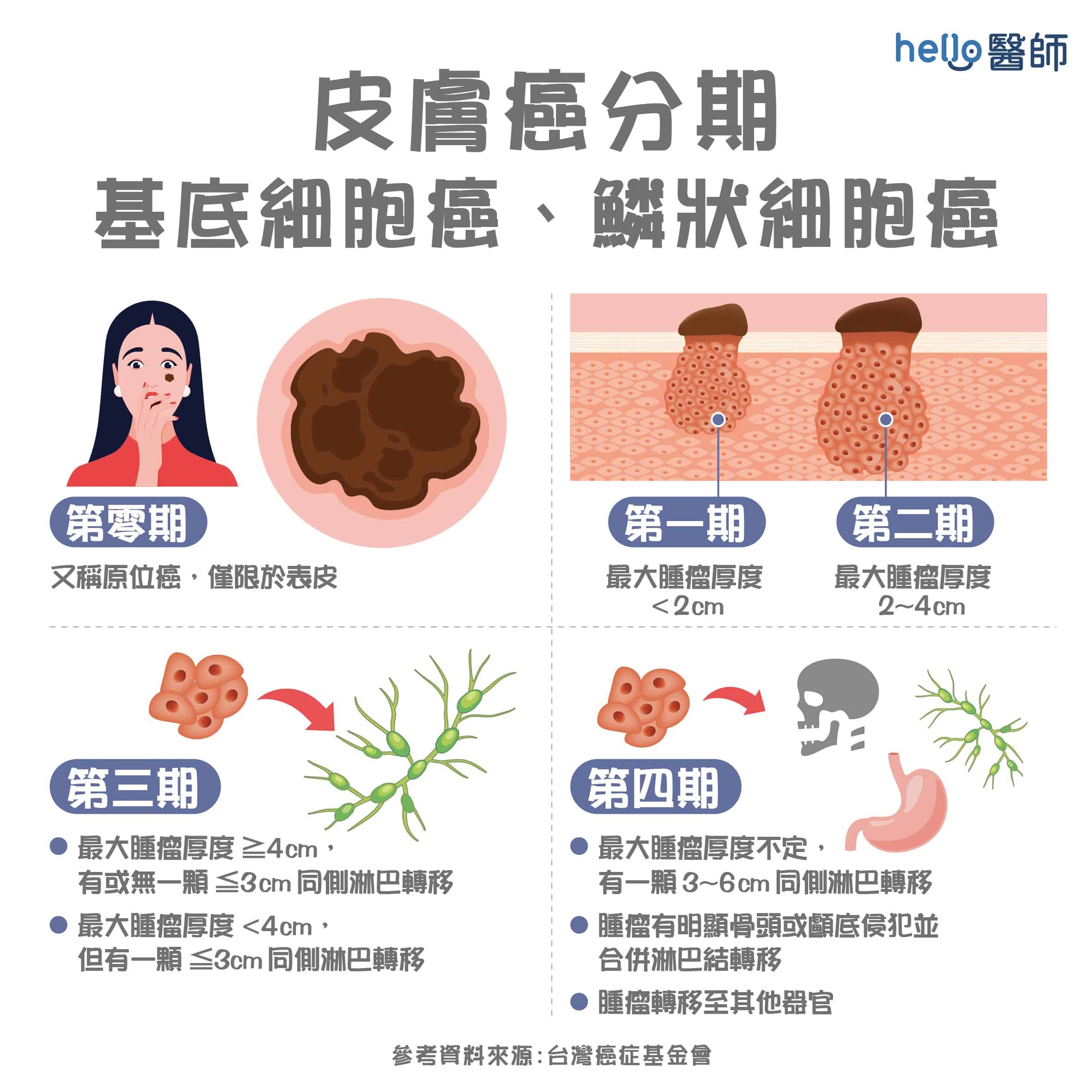 皮膚癌分期:基底細胞癌、鱗狀細胞癌 (Hello醫師授權使用) 皮膚癌分期:基底細胞癌、鱗狀細胞癌 (Hello醫師授權使用)
