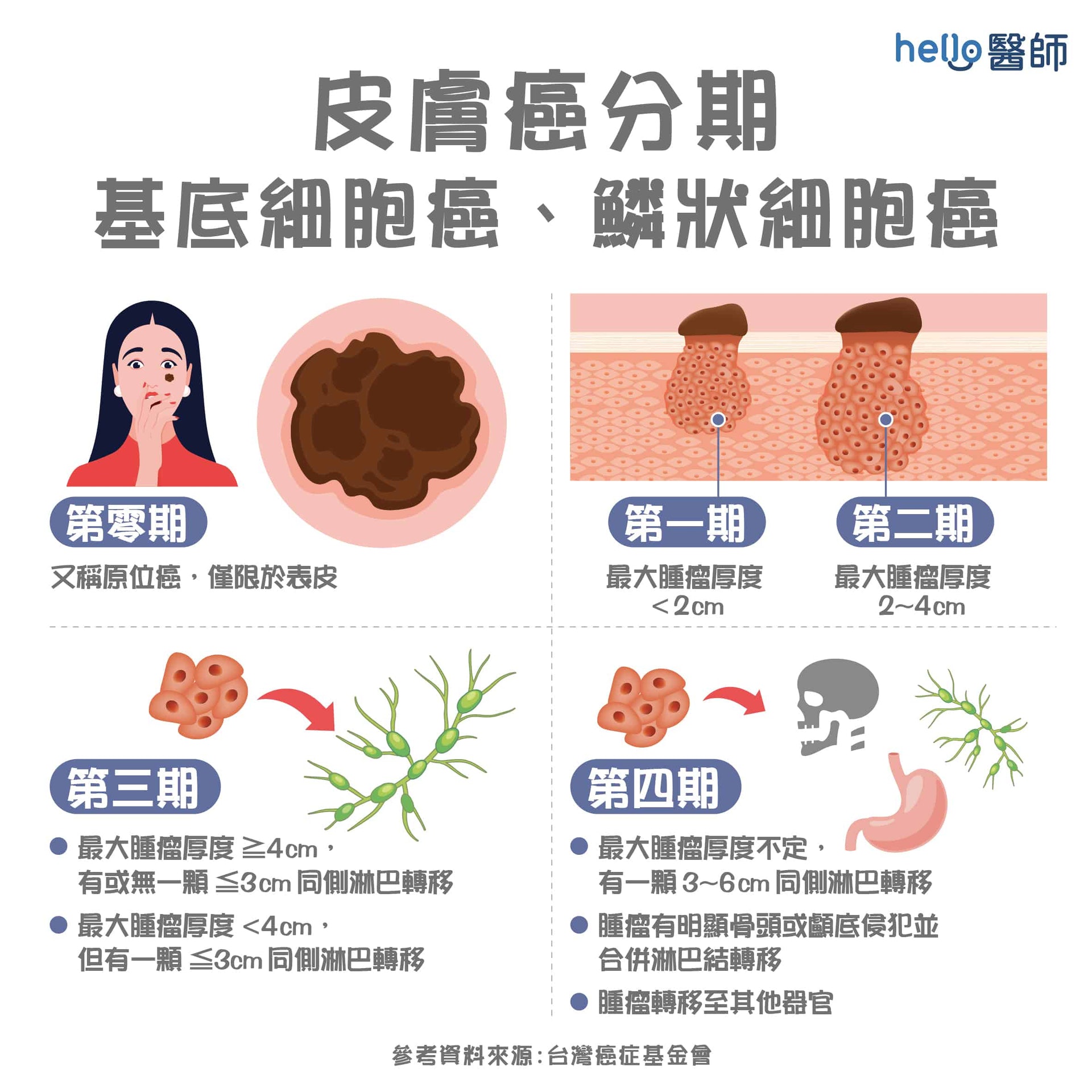 皮膚癌分期：基底細胞癌、鱗狀細胞癌 （Hello醫師授權使用）