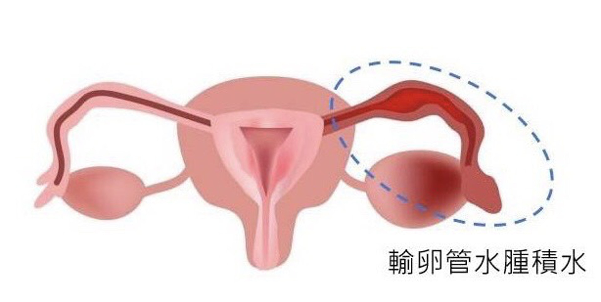積水是無法排走的輸卵管分泌物，不斷在宮腔內流動，影響胚胎與子宮內膜的接觸及著床。（圖片：fertilitylife）