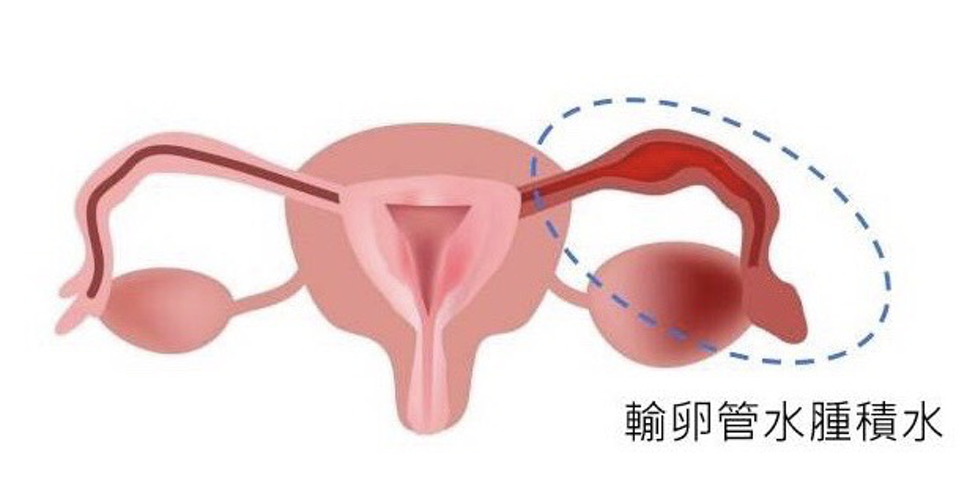 積水是無法排走的輸卵管分泌物,不斷在宮腔內流動,影響胚胎與子宮內膜的接觸及著床。(圖片:fertilitylife) 積水是無法排走的輸卵管分泌物,不斷在宮腔內流動,影響胚胎與子宮內膜的接觸及著床。(圖片:fertilitylife)