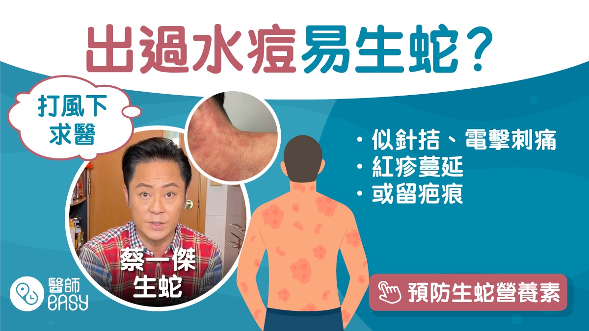 生蛇 蔡一傑風球下求診嘆痛到無命可經空氣傳播把握72小時求醫 香港01 健康