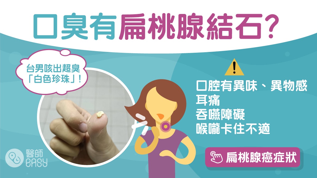 扁桃腺結石|台男咳出酸臭「白色珍珠」 唔飲水常煙酒高危注意! 扁桃腺結石|台男咳出酸臭「白色珍珠」 唔飲水常煙酒高危注意!