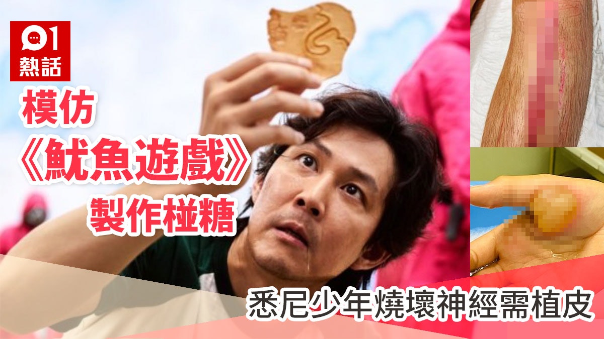 模仿《魷魚遊戲》自製椪糖 少年嚴重燙傷 燒壞神經或需植皮 模仿《魷魚遊戲》自製椪糖 少年嚴重燙傷 燒壞神經或需植皮