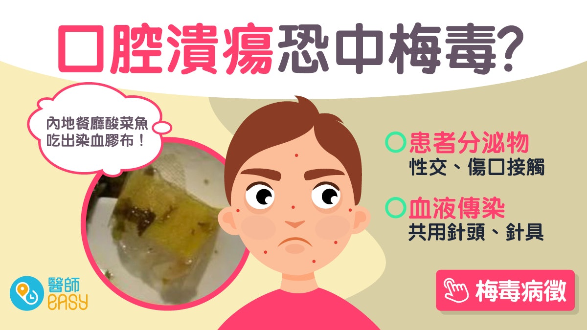 梅毒|內地夫婦食酸菜魚驚見染血膠布 初期中招無痛無癢難發現? 梅毒|內地夫婦食酸菜魚驚見染血膠布 初期中招無痛無癢難發現?