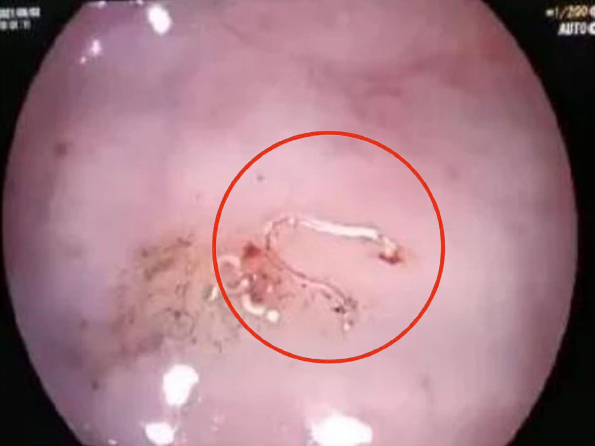 刺身 每月吃兩次仍禍從口入少女腸道布滿寄生蟲刺身應點食安全 刺身 每月吃兩次仍禍從口入少女腸道布滿寄生蟲刺身應點食安全