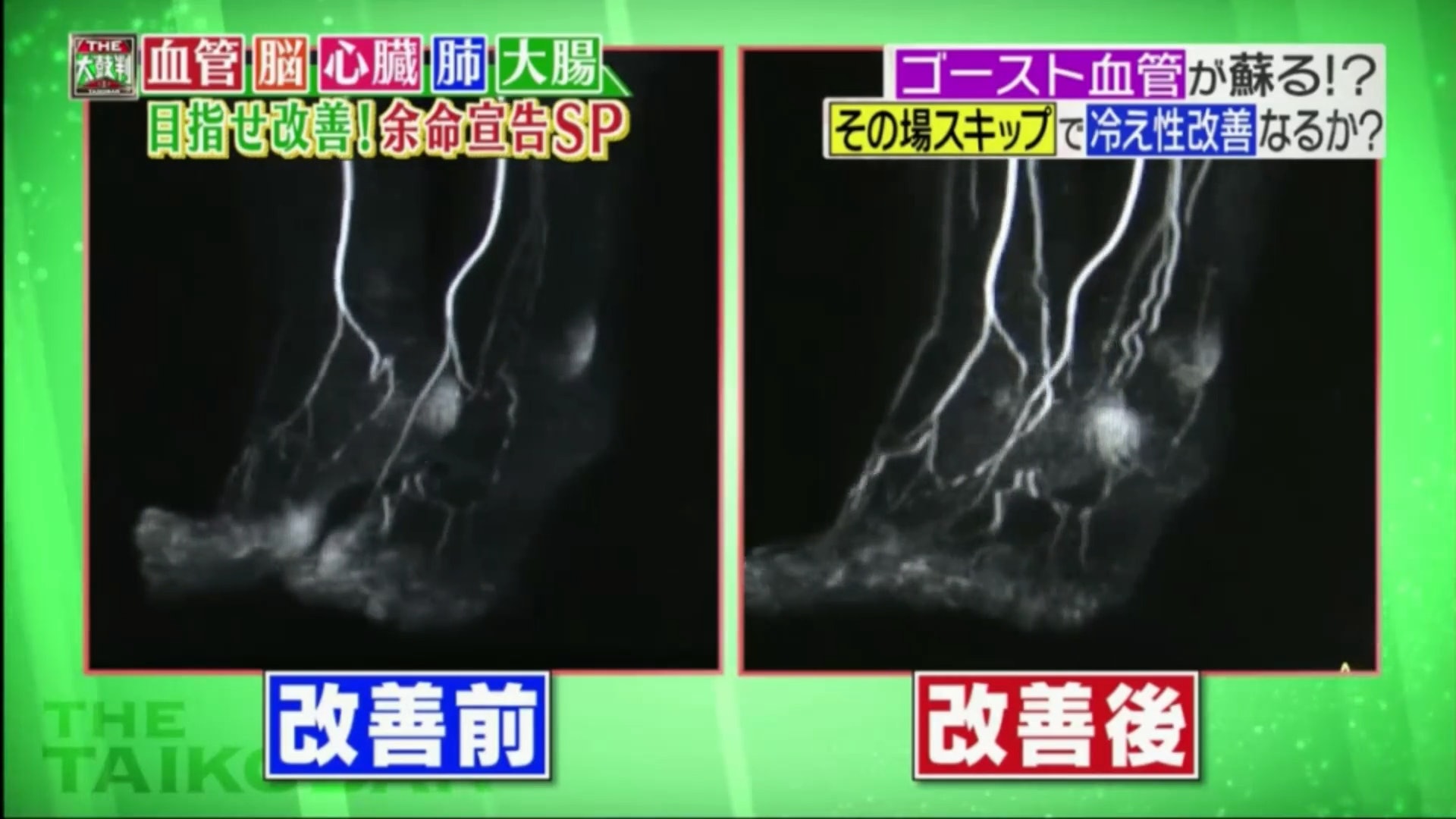 除了矢部太郎外，節目組另外請一位同樣受手腳冰冷困擾的女士進行一星期實測。（《名医のTHE太鼓判！》截圖）