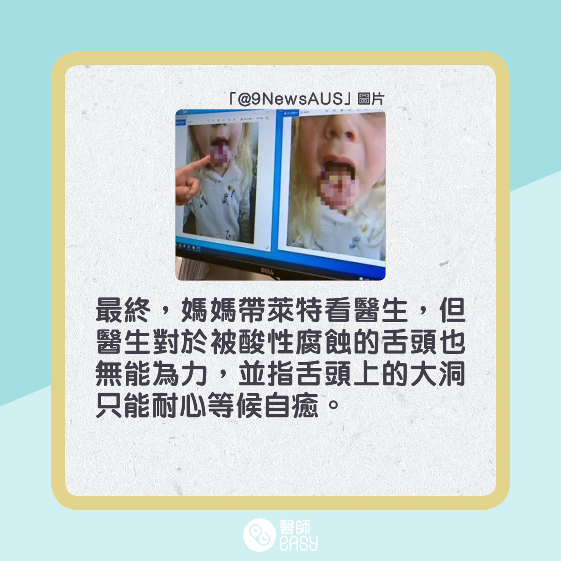 澳洲4歲女童萊德因為吃酸糖而嚴重灼傷舌頭。(01製圖) 澳洲4歲女童萊德因為吃酸糖而嚴重灼傷舌頭。(01製圖)