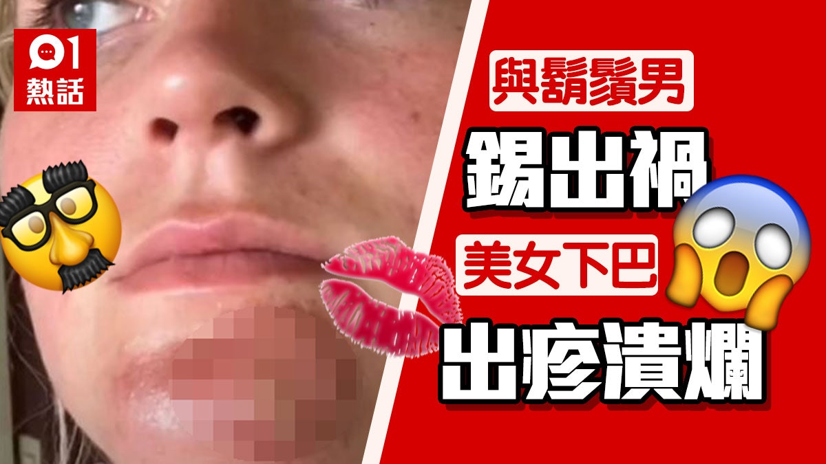 女子吻鬍鬚男後下巴潰爛險毀容網友 不潔鬍鬚比廁板更髒 女子吻鬍鬚男後下巴潰爛險毀容網友 不潔鬍鬚比廁板更髒