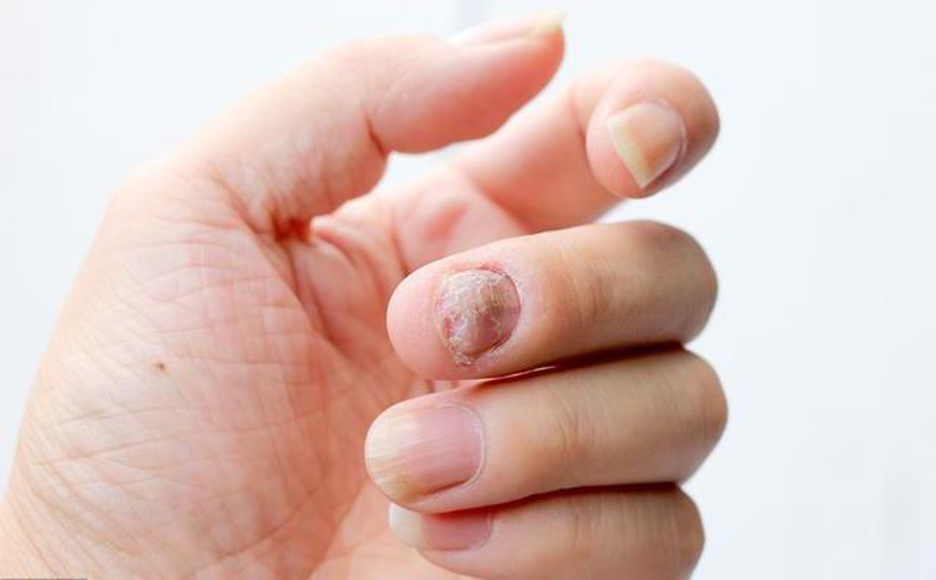 Gel甲使原本的指甲脆弱，一旦受外力撞擊，有機會扯開指甲，令指甲從甲床剝離，需要極長時間康復。（圖片：twgreatdaily）
