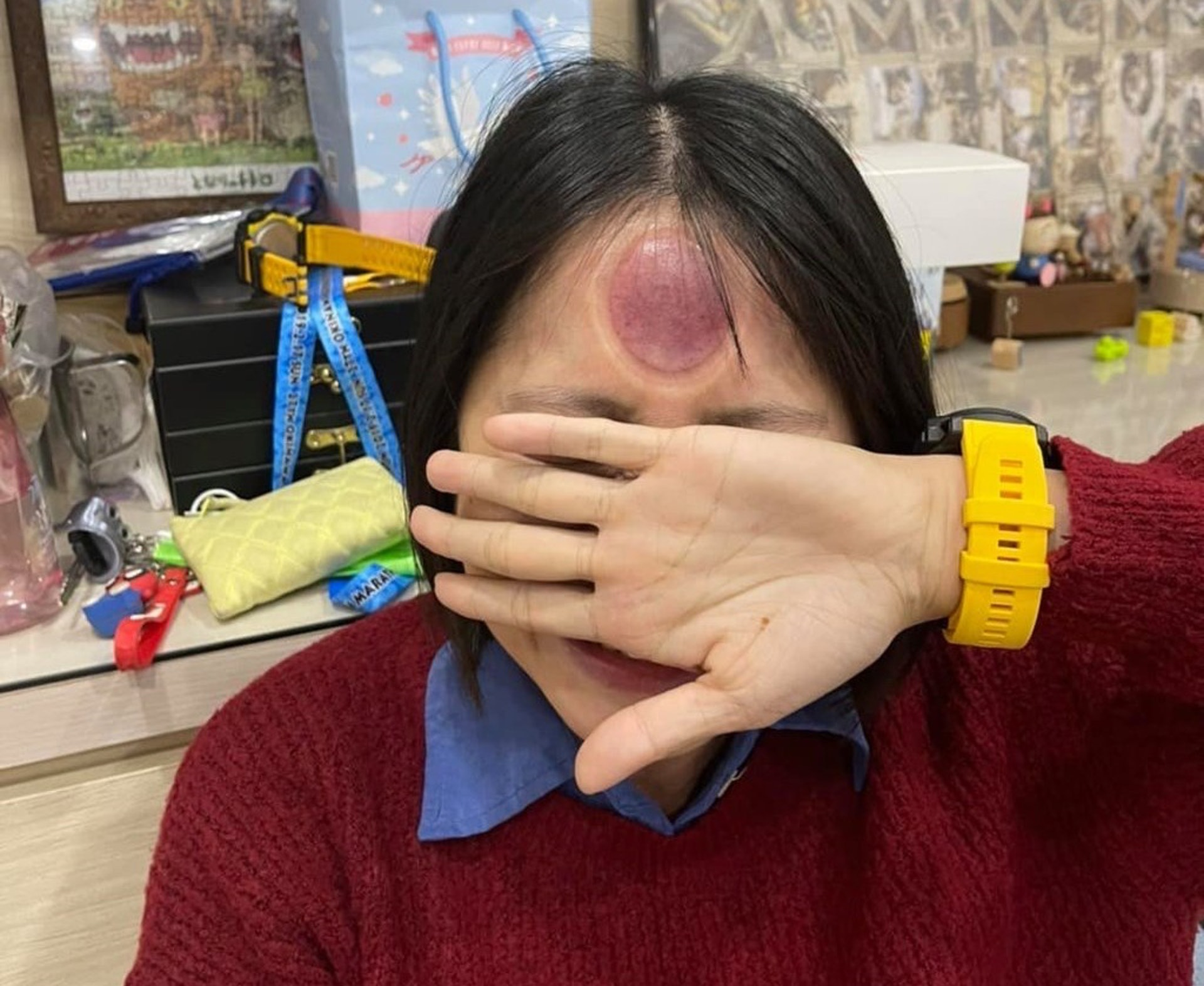 妹妹的額頭在拔罐後,留下一個巨大的瘀血拔罐印。(爆廢公社) 妹妹的額頭在拔罐後,留下一個巨大的瘀血拔罐印。(爆廢公社)