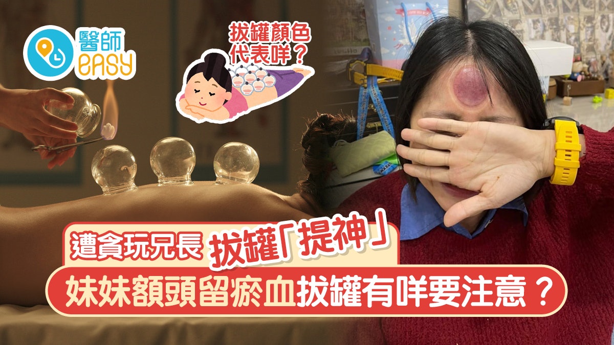 拔罐|遭貪玩兄長拔罐「提神」 妹妹額頭留瘀血拔罐有咩要注意? 拔罐|遭貪玩兄長拔罐「提神」 妹妹額頭留瘀血拔罐有咩要注意?