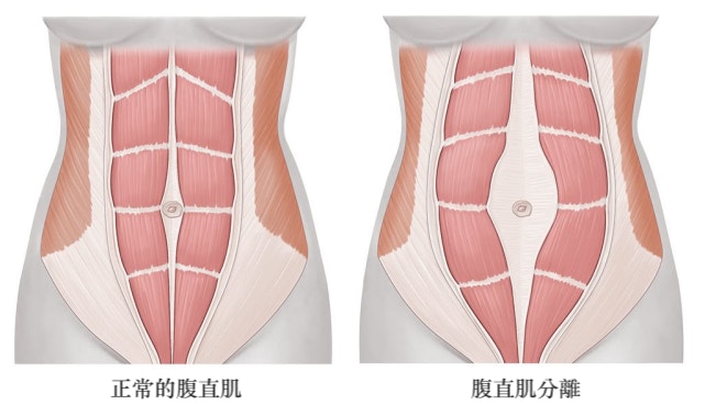 腹直肌一旦分離，不管如何勤做收腰、減肚腩的訓練，都只會事倍功半。有了紮肚這個方法，問題便迎刃而解。（圖片：qq）