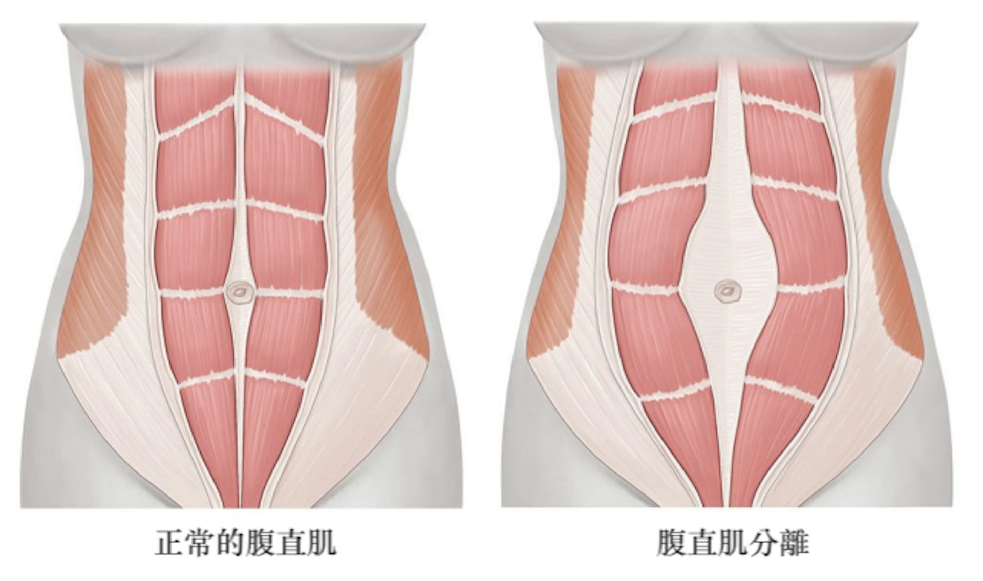 腹直肌一旦分離，不管如何勤做收腰、減肚腩的訓練，都只會事倍功半。有了紮肚這個方法，問題便迎刃而解。（圖片：qq）