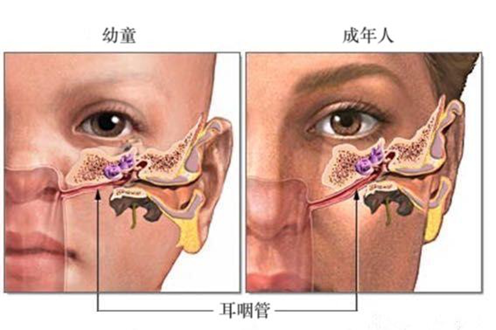 小童的免疫力較弱，加上耳咽管構造較短、處於水平線位置，因此鼻竇、鼻腔或咽喉等上呼吸道部位出現感染時，會更容易逆流到中耳，引發中耳炎。（圖片：sohu）