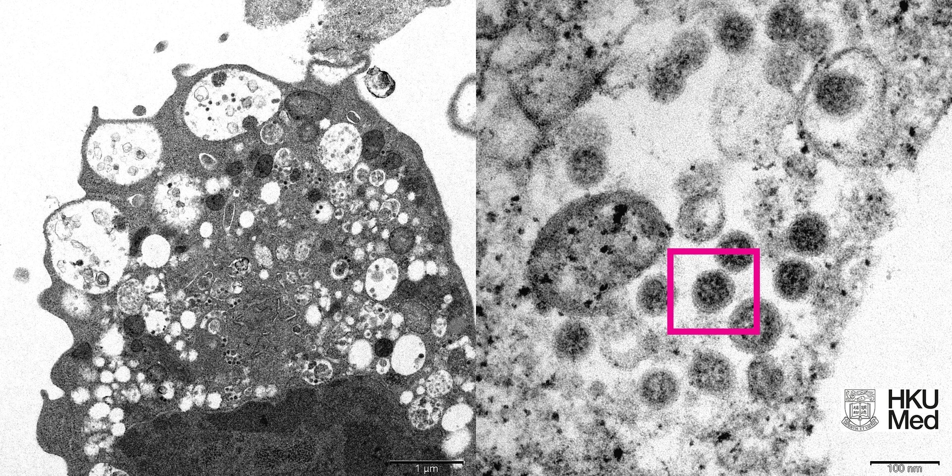 Vero E6細胞受感染後出現腫脹囊泡(左圖)，Vero E6細胞中的病毒顆粒則呈現皇冠形的刺突蛋白(紅框)。(港大醫學院提供)