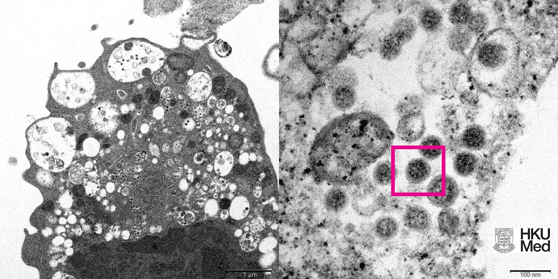 Vero E6細胞受感染後出現腫脹囊泡(左圖),Vero E6細胞中的病毒顆粒則呈現皇冠形的刺突蛋白(紅框)。(港大醫學院提供) Vero E6細胞受感染後出現腫脹囊泡(左圖),Vero E6細胞中的病毒顆粒則呈現皇冠形的刺突蛋白(紅框)。(港大醫學院提供)
